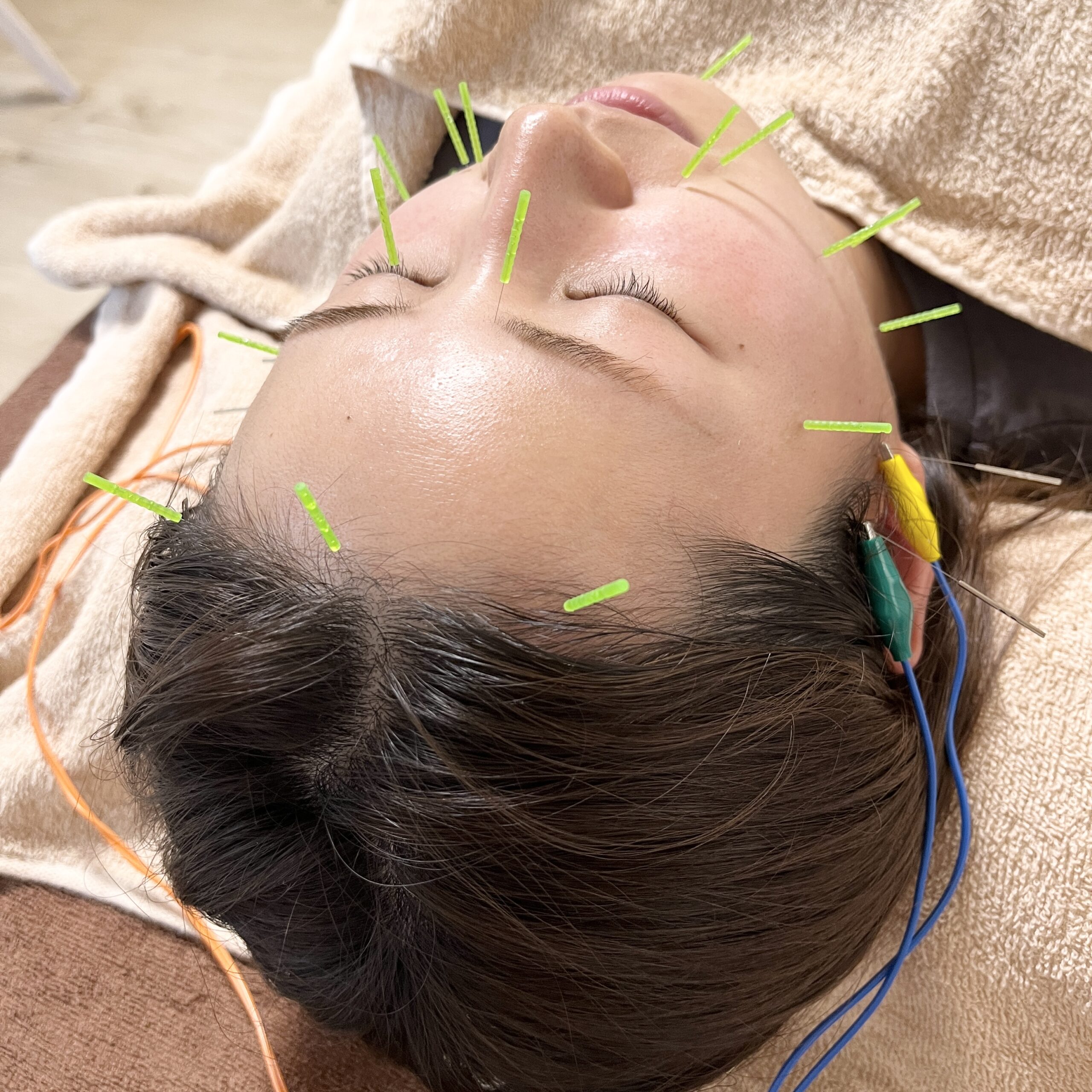 3.16 鍼灸院 はりのひと（美容鍼モニター様）